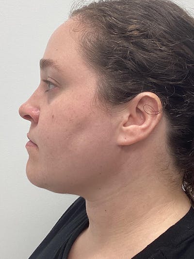 Liposuction Before & After Gallery - Patient 210011 - Image 2