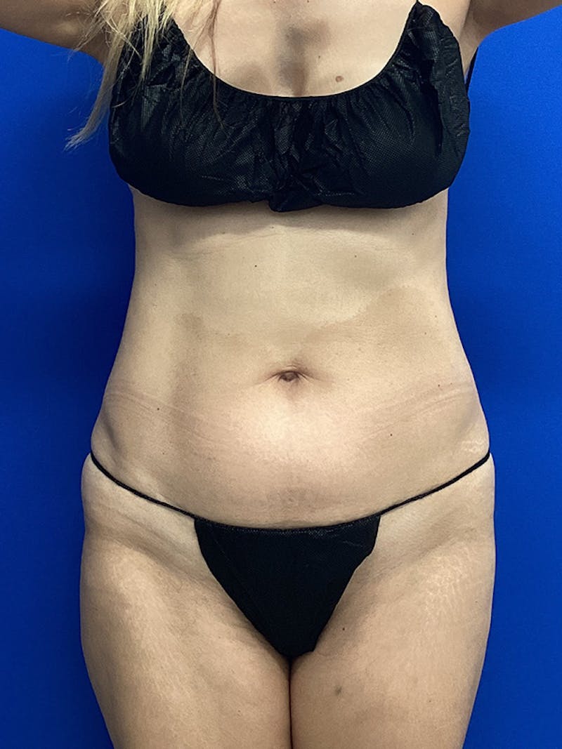 Patient X4zctBXsTnGazvJ979nWdQ - Liposuction Before & After Photos