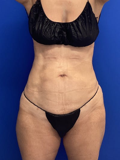 Liposuction Before & After Gallery - Patient 390941 - Image 2