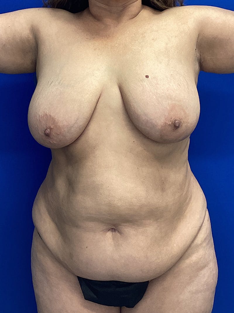 Patient b_j1XkzrRKCBQwBWGgkuqQ - Breast Lift Before & After Photos