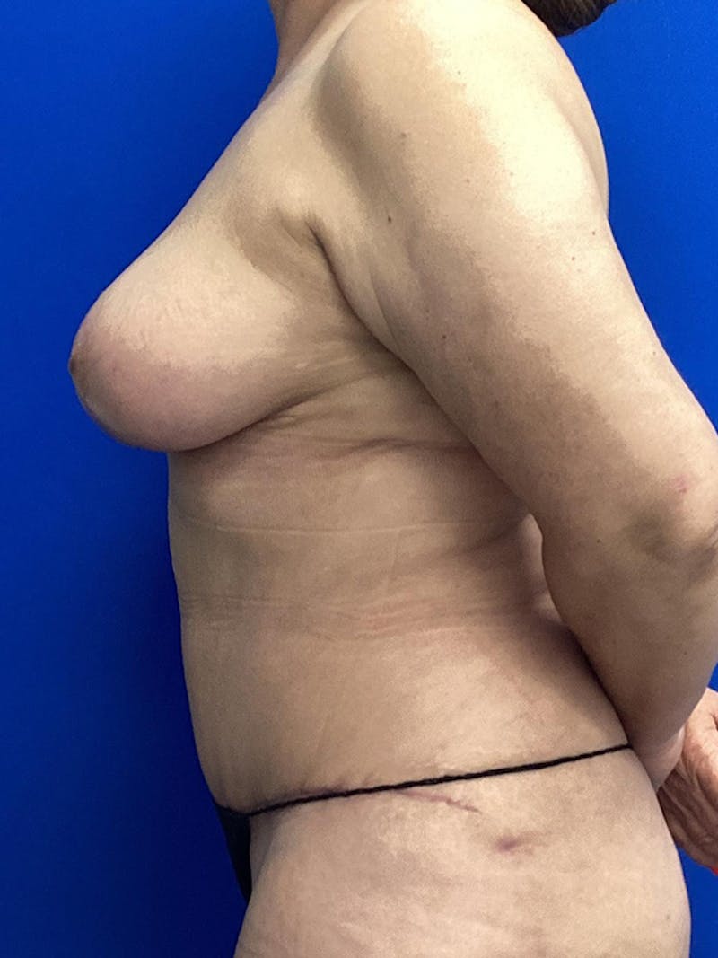 Mommy Makeover Before & After Gallery - Patient 366889 - Image 4