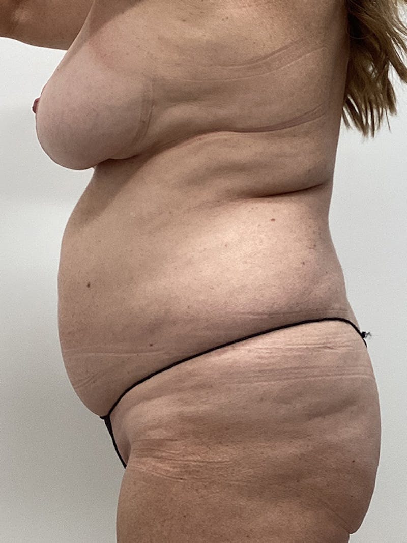 Mommy Makeover Before & After Gallery - Patient 417041 - Image 3