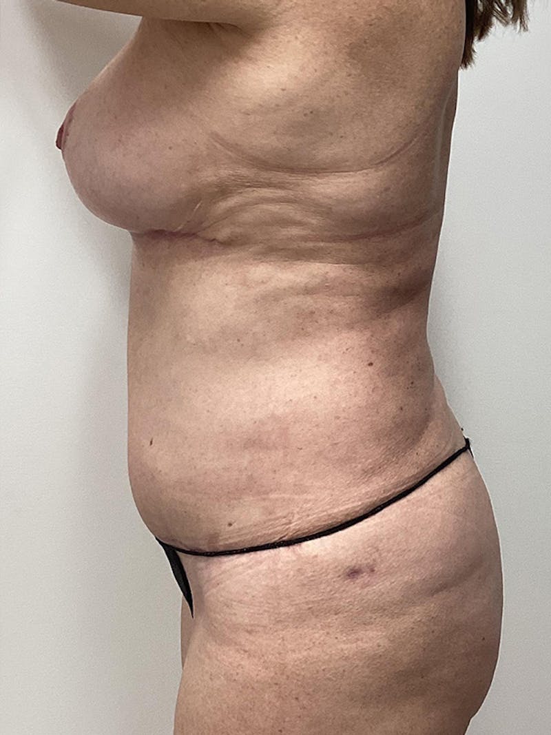 Mommy Makeover Before & After Gallery - Patient 417041 - Image 4