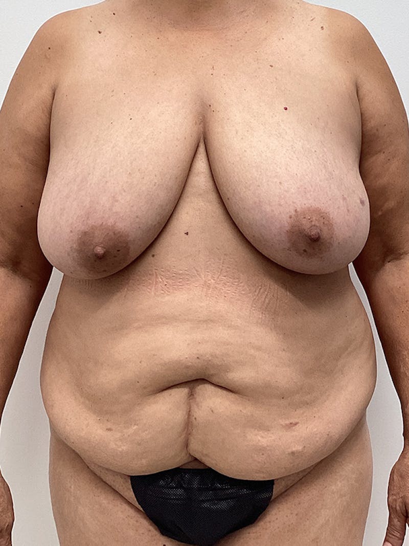 Patient TK5Q6J20Toit0nltJwdT-A - Tummy Tuck Before & After Photos