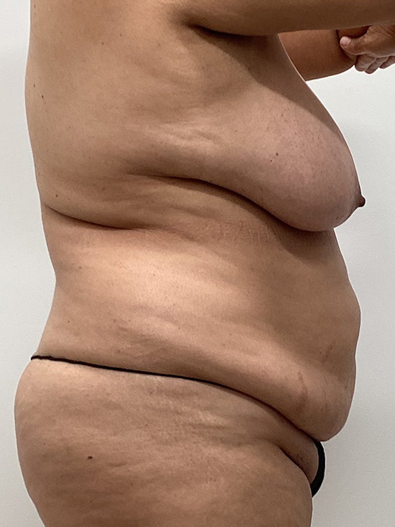 Mommy Makeover Before & After Gallery - Patient 150868 - Image 3