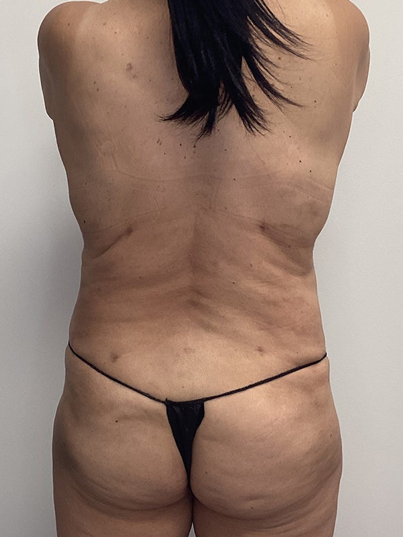 Mommy Makeover Before & After Gallery - Patient 150868 - Image 6