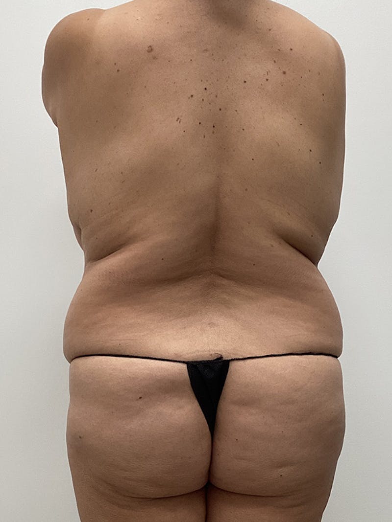Mommy Makeover Before & After Gallery - Patient 150868 - Image 5