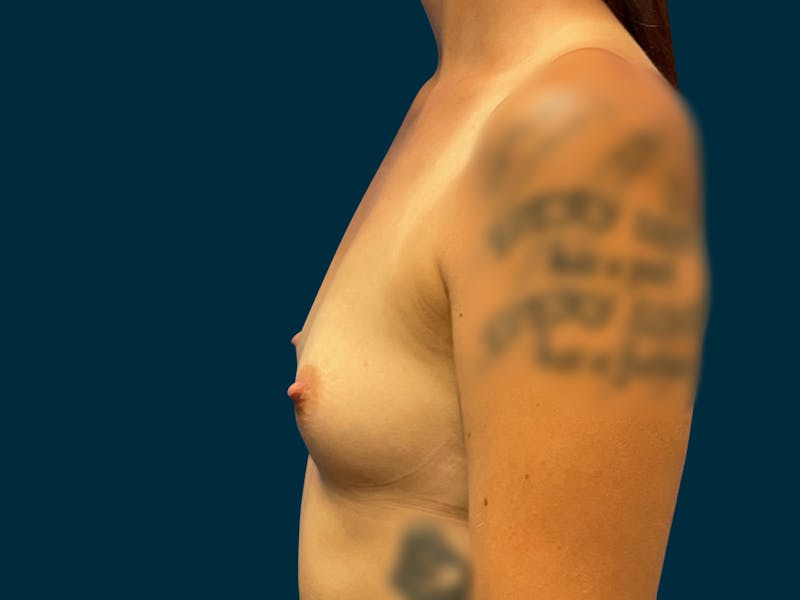 Breast Augmentation Before & After Gallery - Patient 264396 - Image 3