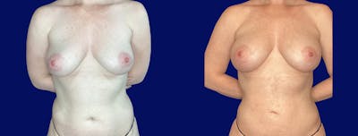 Fat Transfer Breast Augmenation Before & After Gallery - Patient 485974 - Image 1