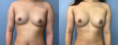 Fat Transfer Breast Augmenation Before & After Gallery - Patient 150641 - Image 1