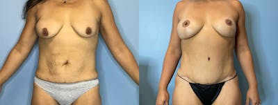Fat Transfer Breast Augmenation Before & After Gallery - Patient 422530 - Image 1