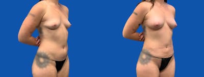 Liposuction Before & After Gallery - Patient 338216 - Image 1