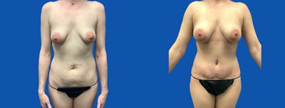 Fat Transfer Breast Augmenation Before & After Gallery - Patient 894885 - Image 1