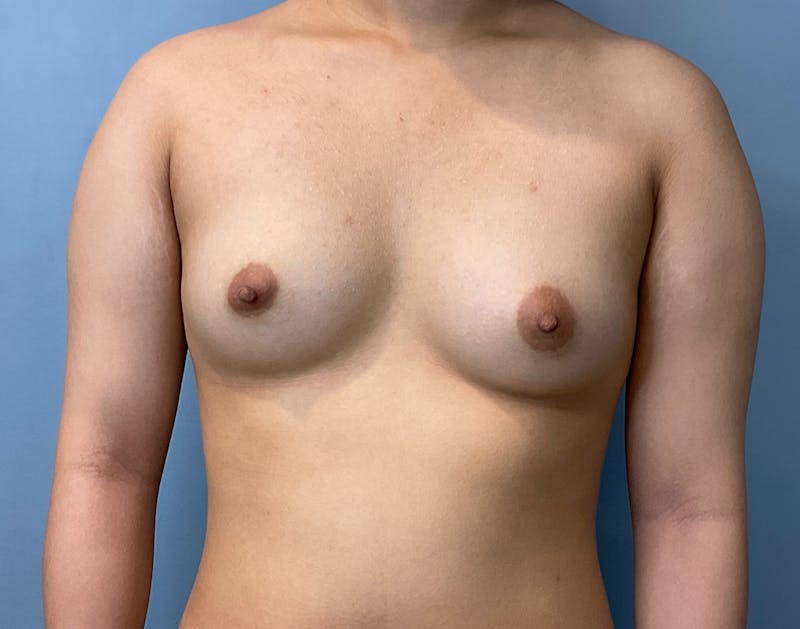 Patient ATompKcsSY2kOLd6Au8Vfw - Fat Transfer Breast Augmentation Before & After Photos