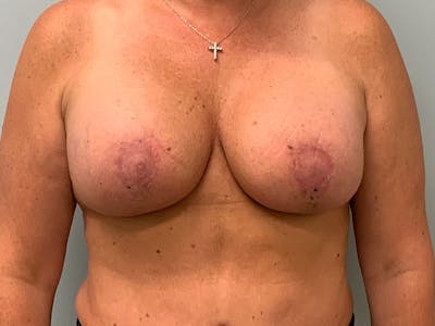 Breast Augmentation & Lift Before & After Gallery - Patient 465802 - Image 2