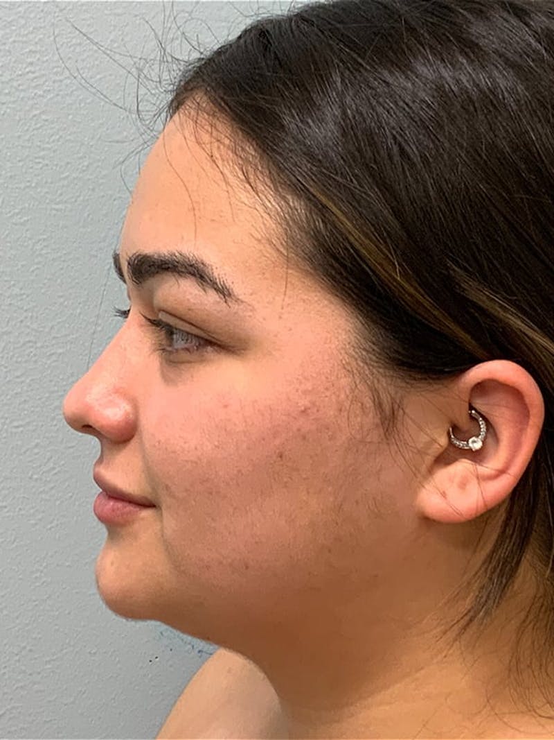 Patient VNRfUhsCSACYFPwziUyjhQ - Chin & Neck Liposuction Before & After Photos