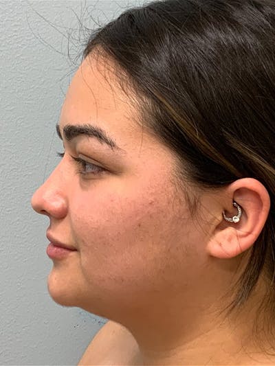 Chin & Neck Liposuction Before & After Gallery - Patient 407406 - Image 1