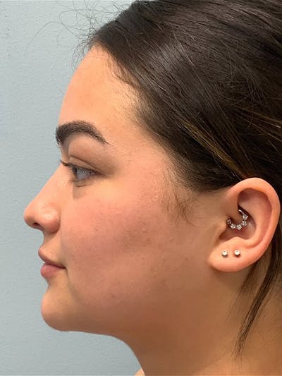 Chin & Neck Liposuction Before & After Gallery - Patient 407406 - Image 2