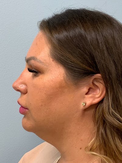 Chin & Neck Liposuction Before & After Gallery - Patient 404186 - Image 1