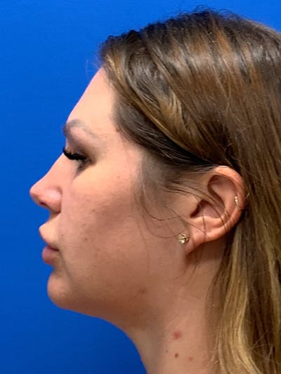Chin & Neck Liposuction Before & After Gallery - Patient 404186 - Image 2