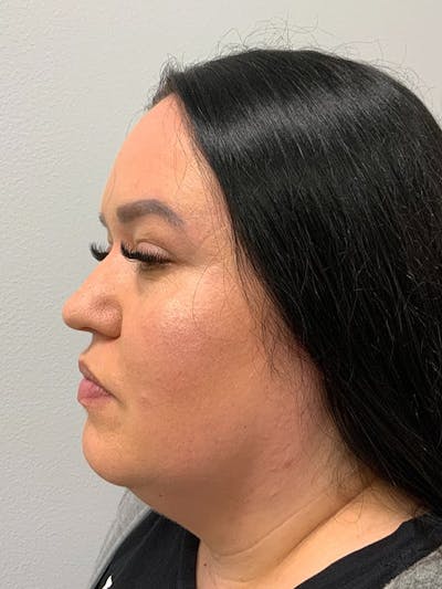 Chin & Neck Liposuction Before & After Gallery - Patient 318793 - Image 1
