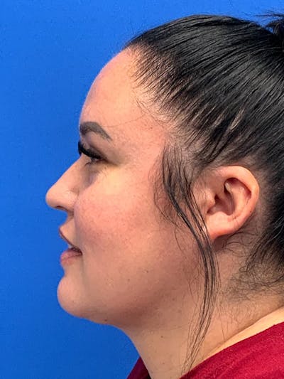 Chin & Neck Liposuction Before & After Gallery - Patient 318793 - Image 2