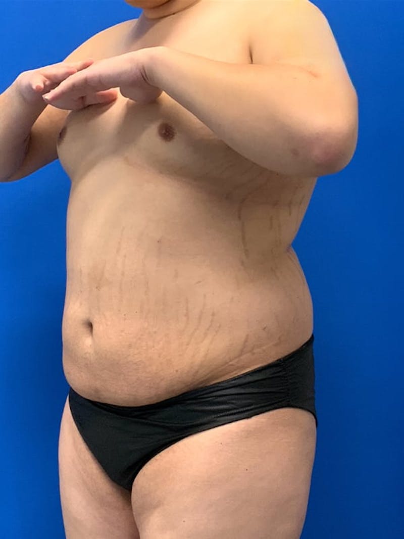 Patient HCd3n7jFSBaihVYYoptu5g - Liposuction Before & After Photos