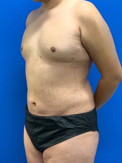 Liposuction Before & After Gallery - Patient 227637 - Image 2