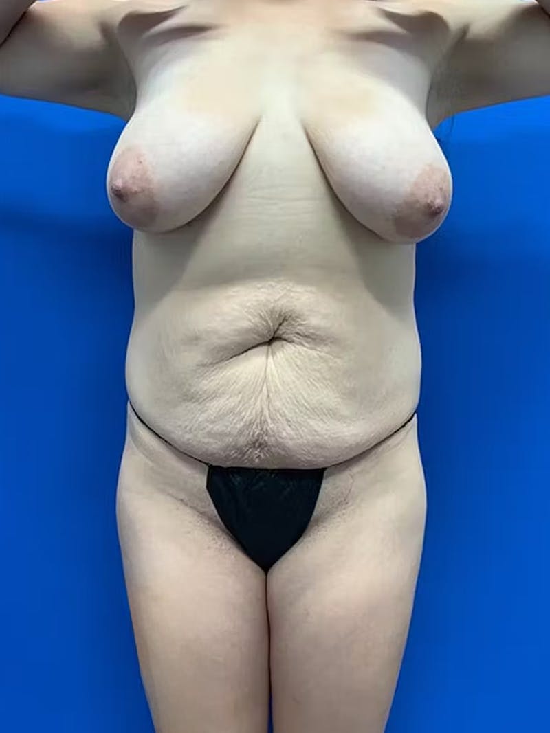 Patient IcnD4gBuTVSN44jSdfyk6Q - Mommy Makeover Before & After Photos