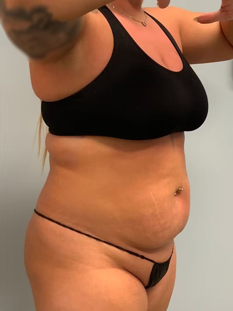 Patient UvjRIHmNRX2Qm3l_4tjGNg - Liposuction Before & After Photos