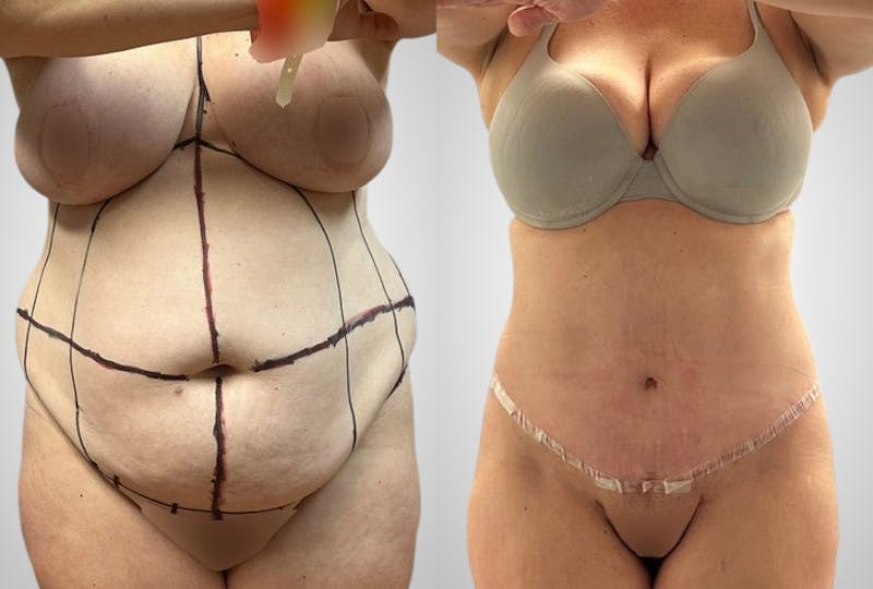 Liposuction Before & After Gallery - Patient 207728 - Image 1