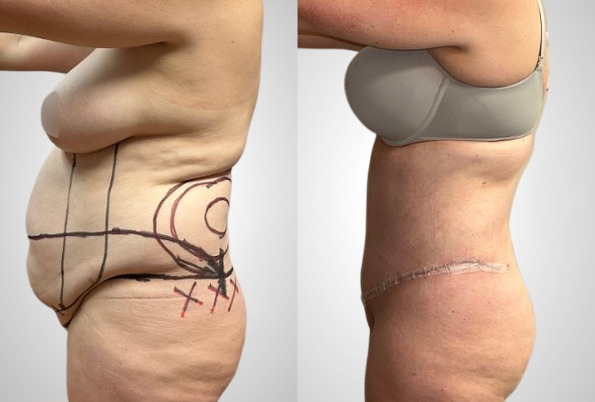 Liposuction Before & After Gallery - Patient 207728 - Image 2