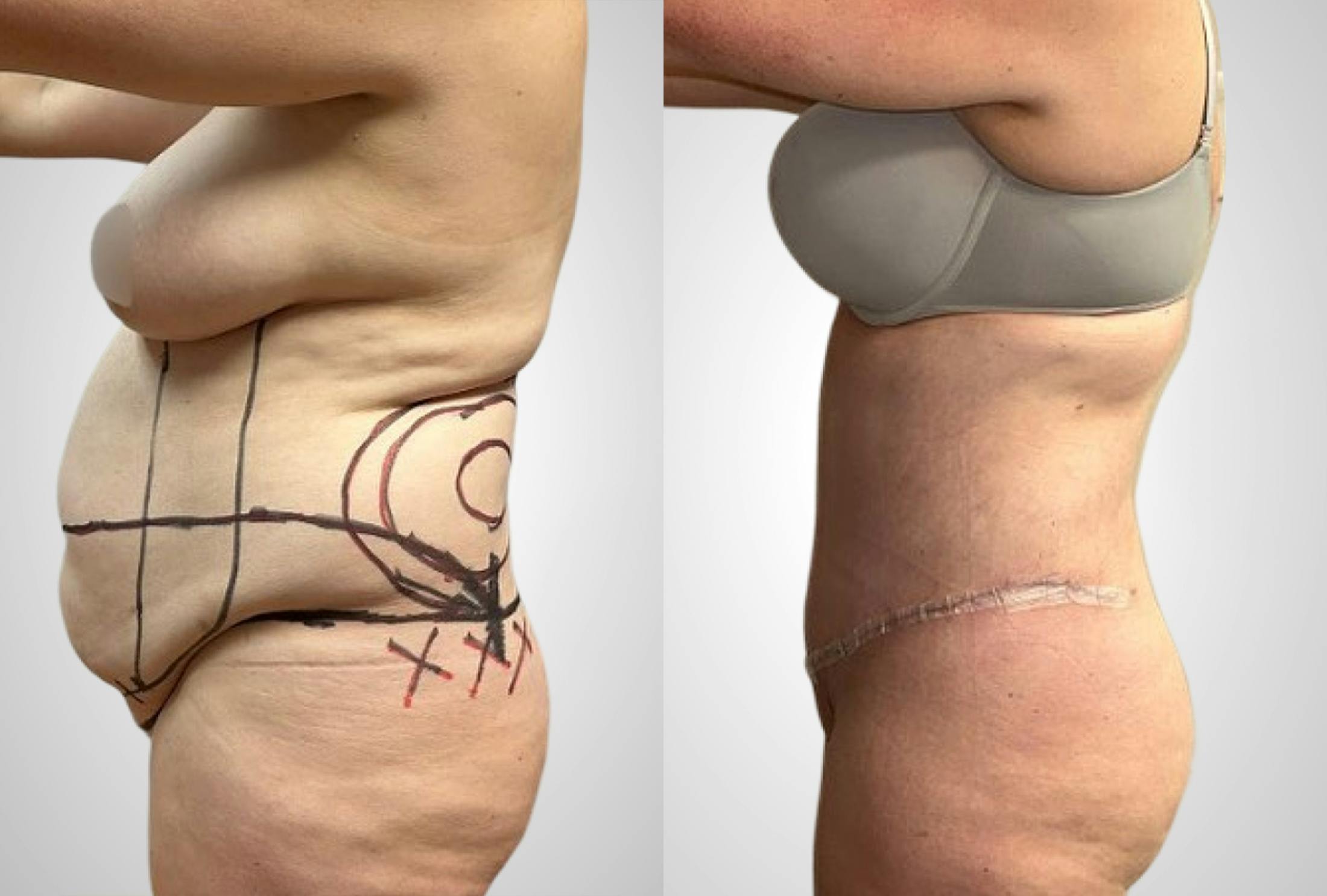 Liposuction Before & After Gallery - Patient 207728 - Image 2