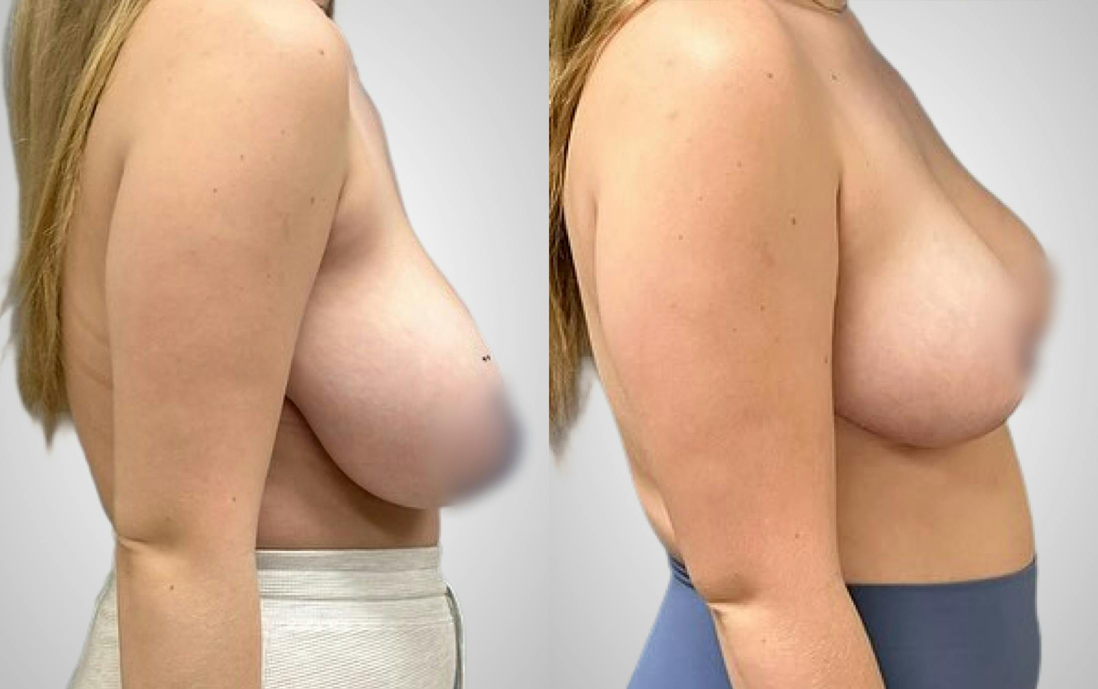 Breast Reduction Before & After Gallery - Patient 513133 - Image 2