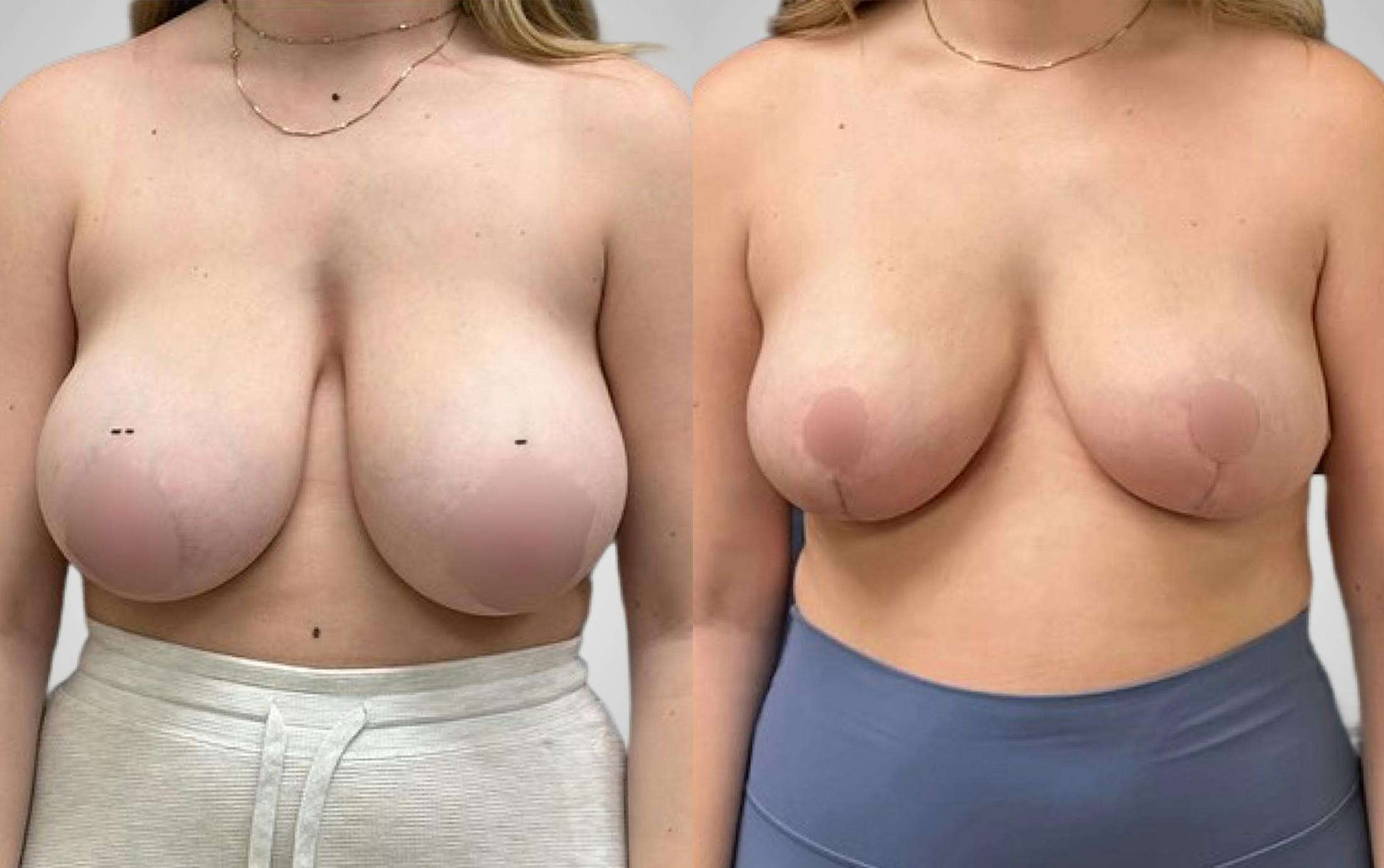 Breast Reduction Before & After Gallery - Patient 513133 - Image 1