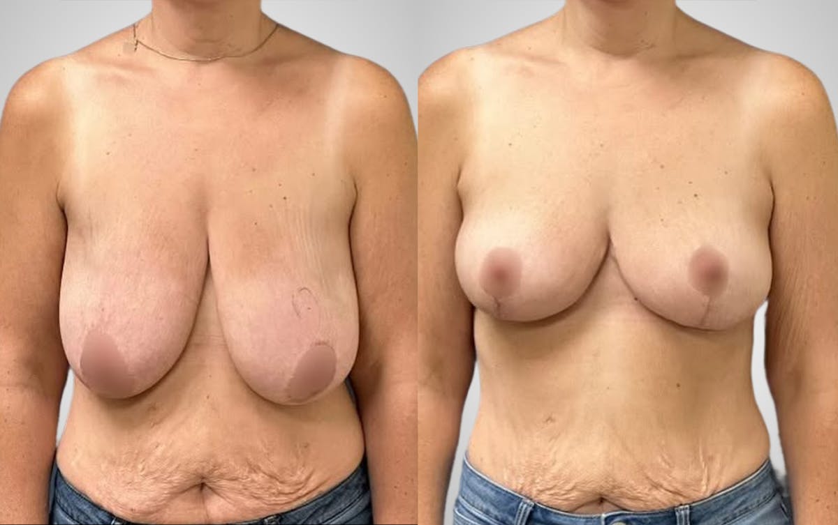 Breast Lift Before & After Gallery - Patient 365733 - Image 1