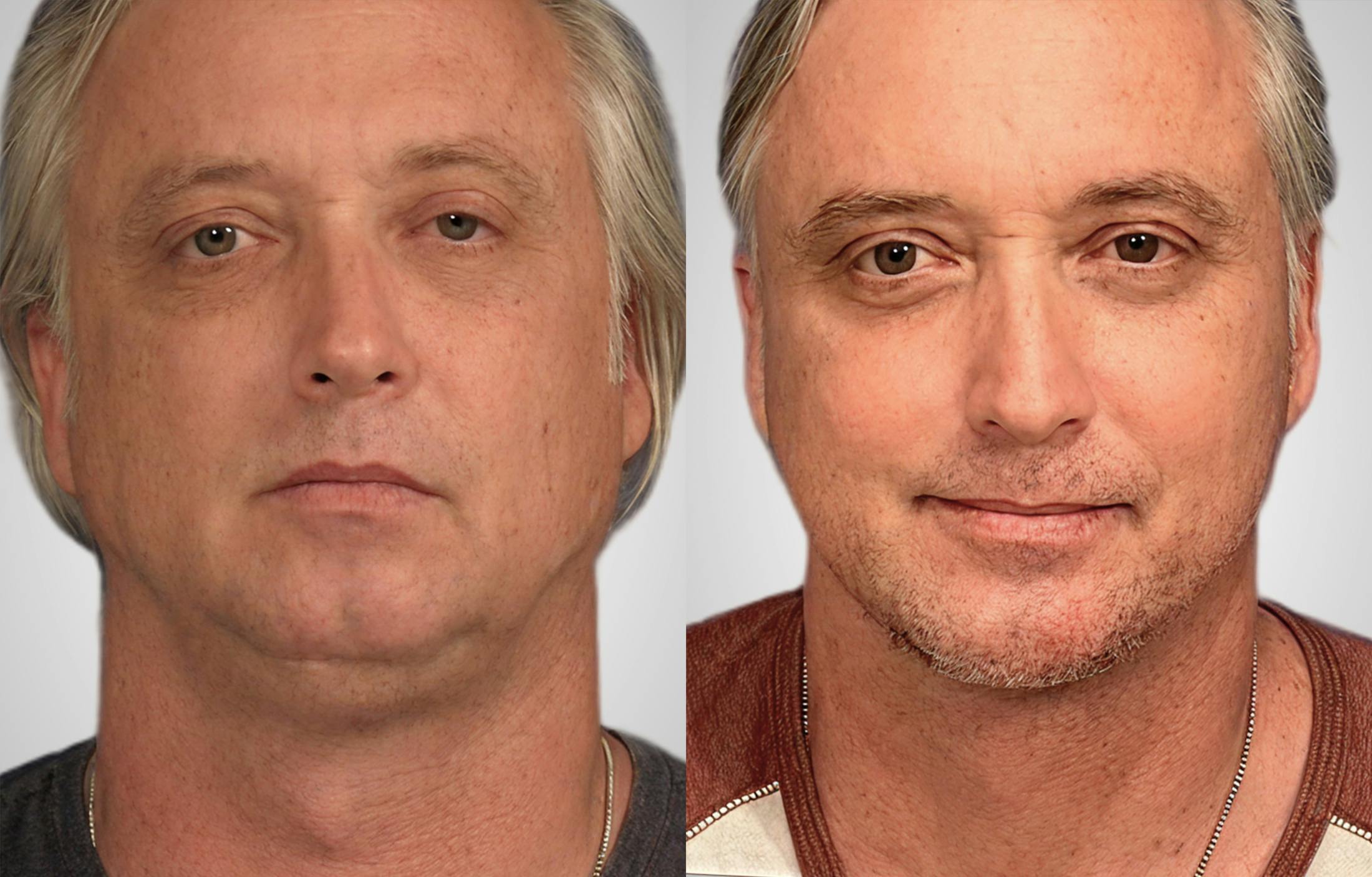 Neck Lift Before & After Gallery - Patient 184943 - Image 3