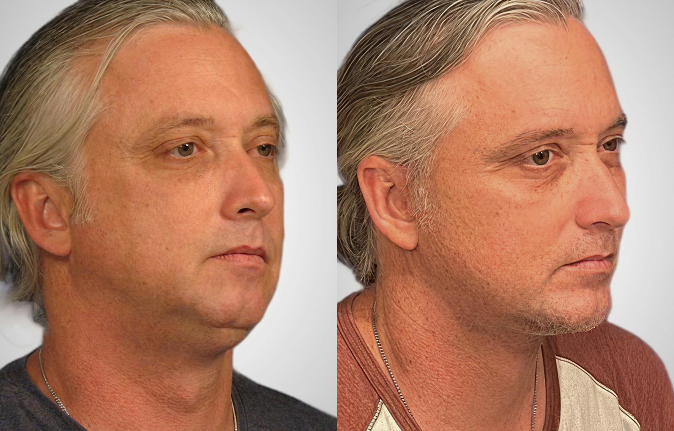 Neck Lift Before & After Gallery - Patient 184943 - Image 2