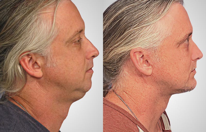 Patient Yz3eUvUOSmmtg5MXOCrK2g - Neck Lift Before & After Photos