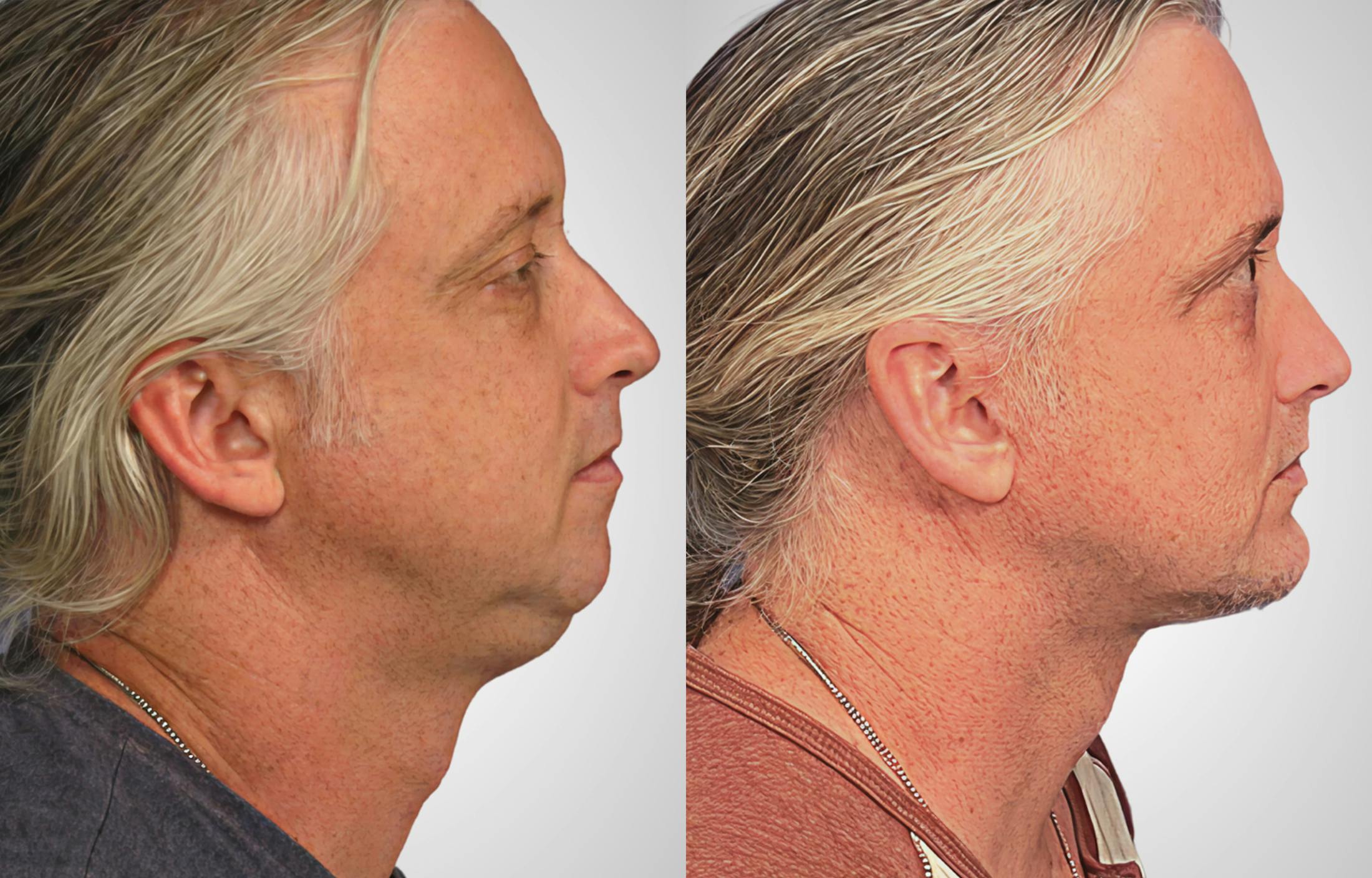 Neck Lift Before & After Gallery - Patient 184943 - Image 1