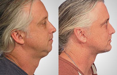 Neck Lift Before & After Gallery - Patient 184943 - Image 1