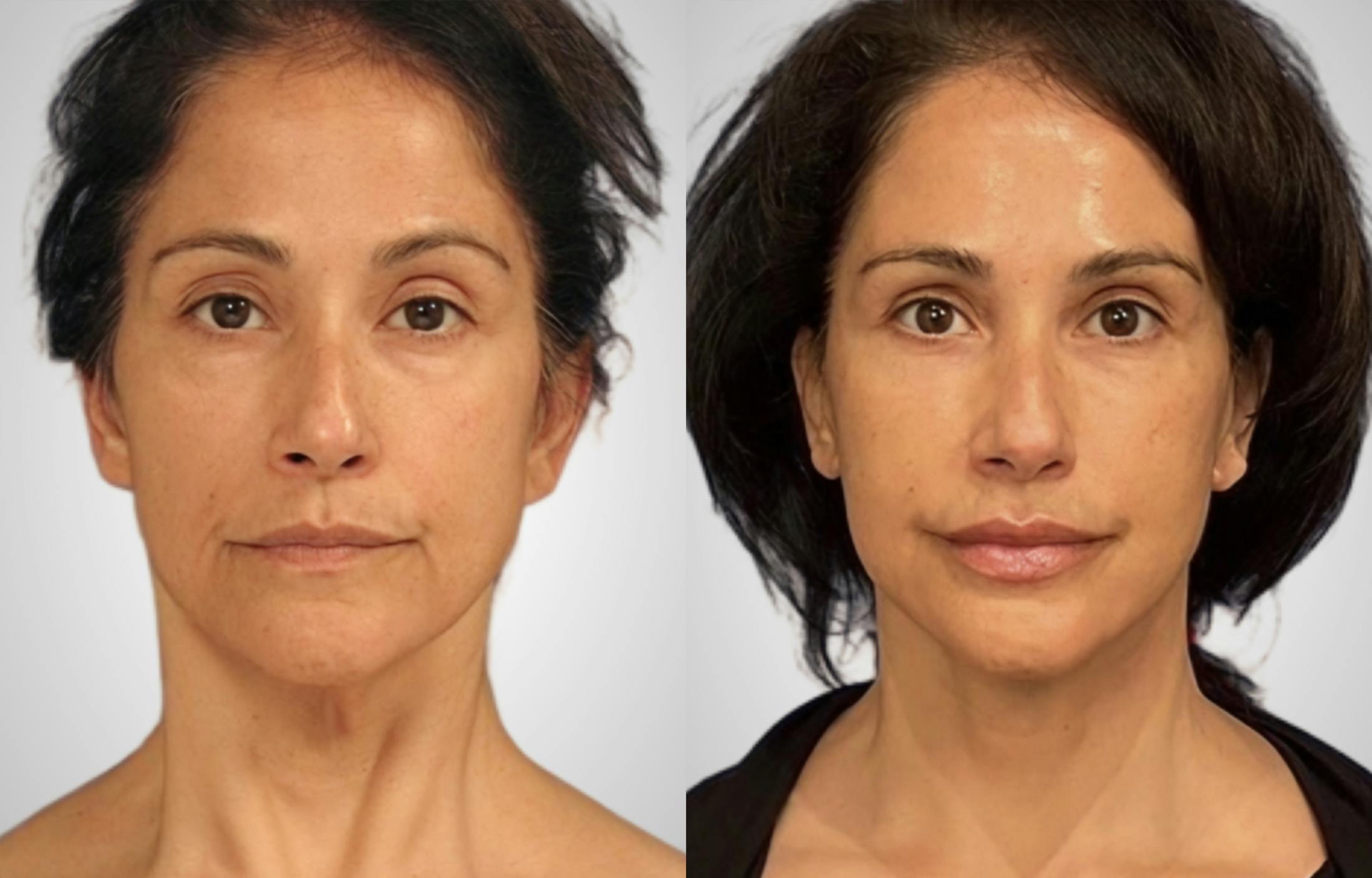 Neck Lift Before & After Gallery - Patient 245738 - Image 2