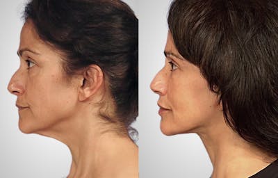 Neck Lift Before & After Gallery - Patient 245738 - Image 1