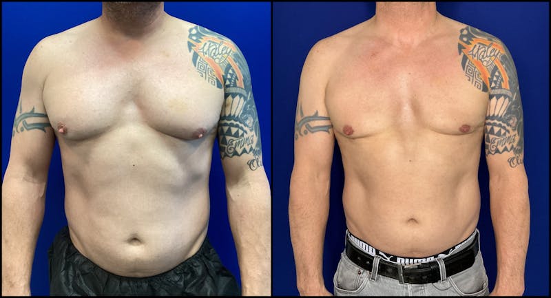 Patient VFuDG0LTSUSeNrGKenFZNA - Gynecomastia Before & After Photos