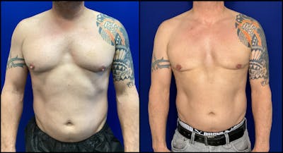 Gynecomastia Before & After Gallery - Patient 330359 - Image 1