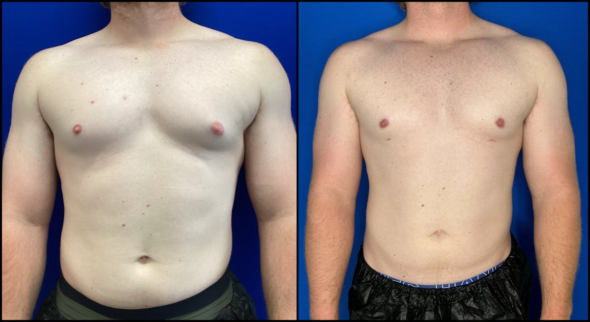 Gynecomastia Before & After Gallery - Patient 180467 - Image 1