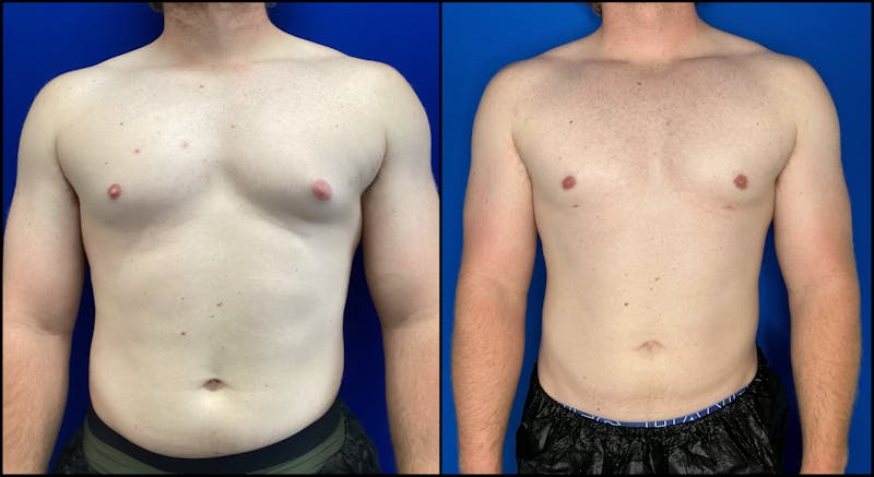Patient FwudmCXpTc6fdXZjUqAmxg - Gynecomastia Before & After Photos