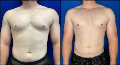 Gynecomastia Before & After Gallery - Patient 180467 - Image 1
