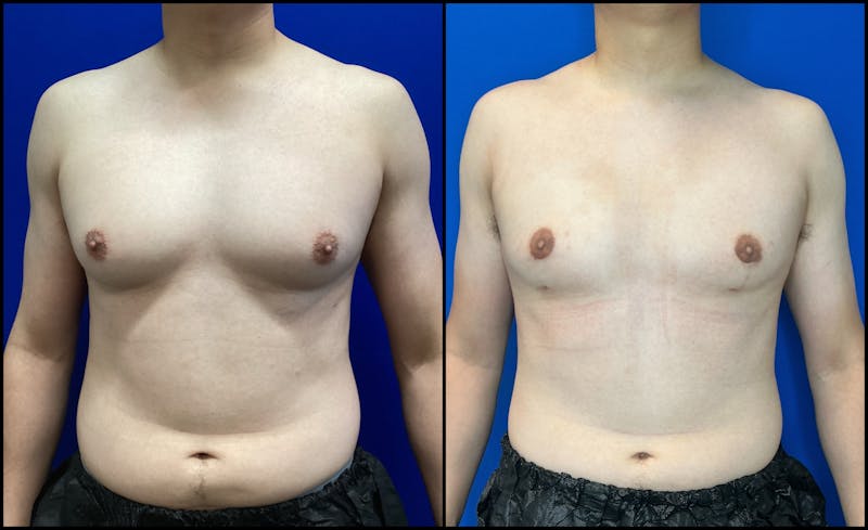 Patient L6AZNYTGSj-F_klaDHnoTw - Gynecomastia Before & After Photos