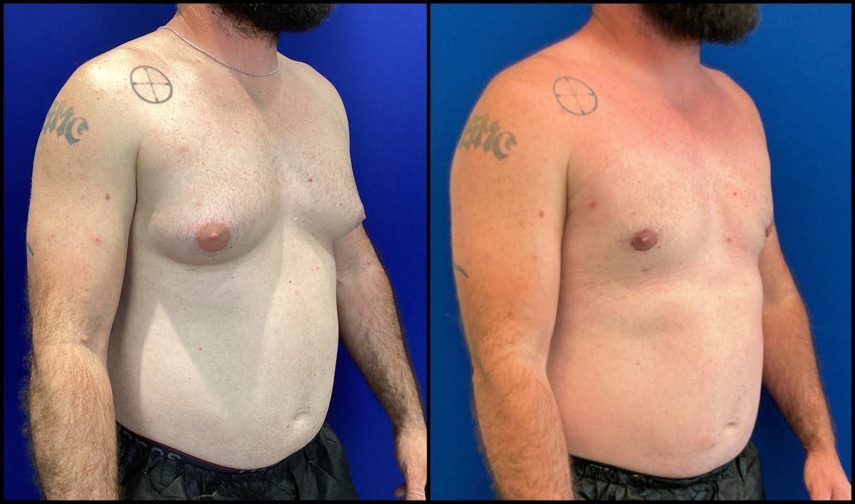 Gynecomastia Before & After Gallery - Patient 158713 - Image 1